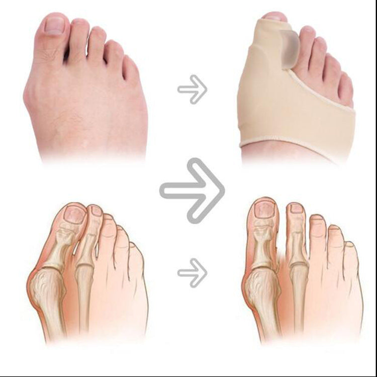 Big Foot Hallux Valgus Corrector – Justerbart Hallux Valgus-skydd och stortåstöd för smärtlindring, dag och natt